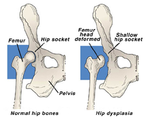 diagram of hip dysplasia